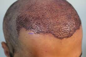 hair transplant costs