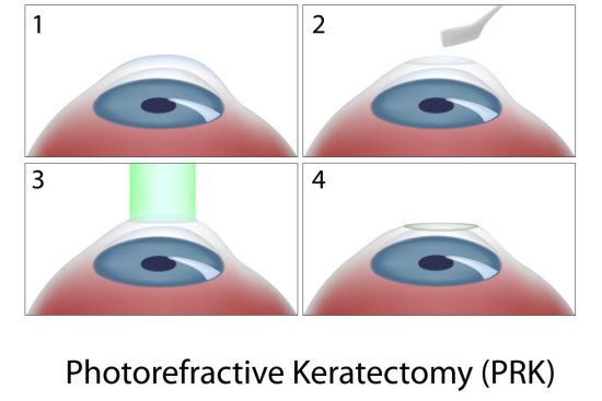 Laser eye surgery cost Brisbane