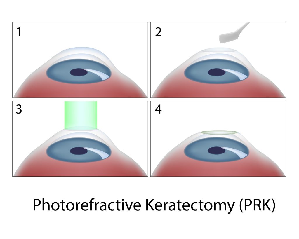 Laser eye surgery cost Brisbane