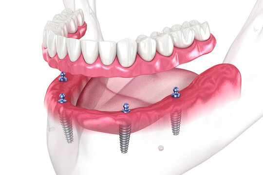 4 dental implants