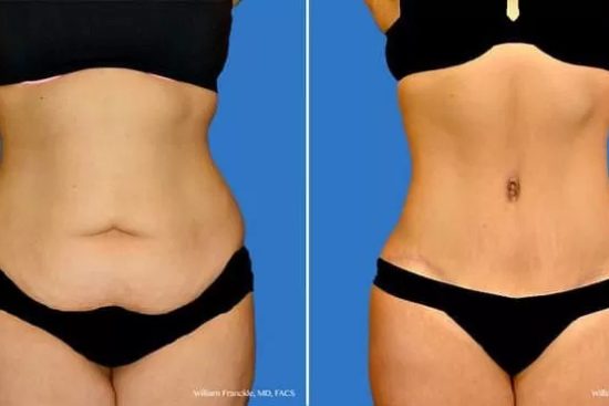 Mini-Abdominoplasty-Clinic-in-Dubai-Abu-Dhabi