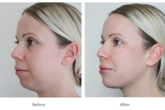 dermal-fillers-full-face-rejuvenation-before-after (1)