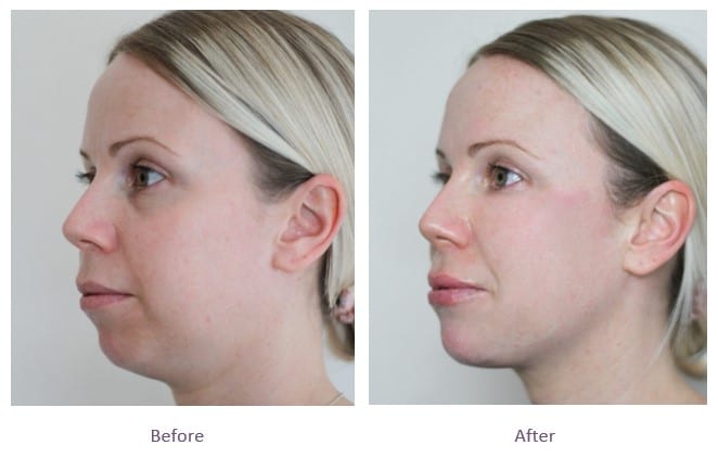 dermal-fillers-full-face-rejuvenation-before-after (1)