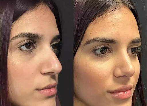 Your Guide to the Best Doctors in Dubai for Rhinoplasty and Facial Enhancements