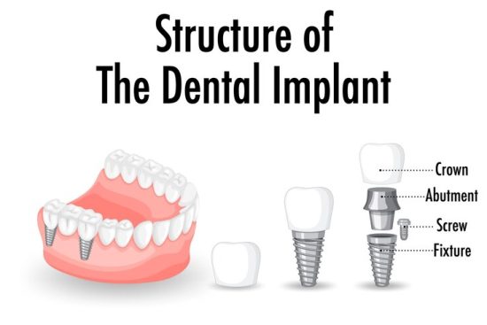 structure-dental-implant-white-background_1308-108997