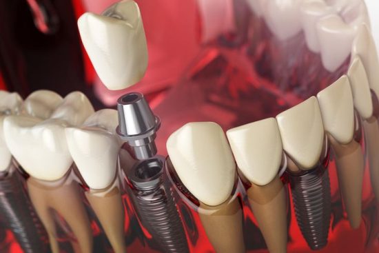 Best Dental Implants in Lahore