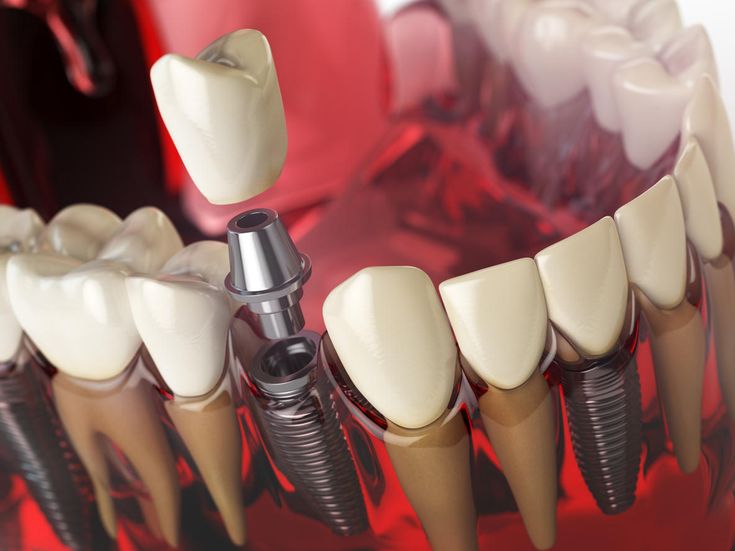 Best Dental Implants in Lahore