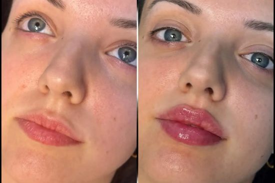 H5-lip-fillers