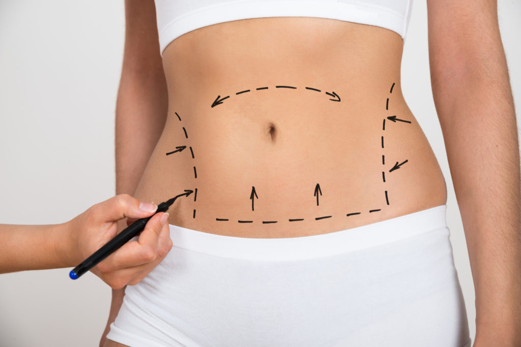 Liposuction Surgery in Dubai