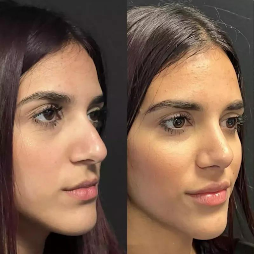 Rhinoplasty in Dubai: How to Choose the Right Surgeon