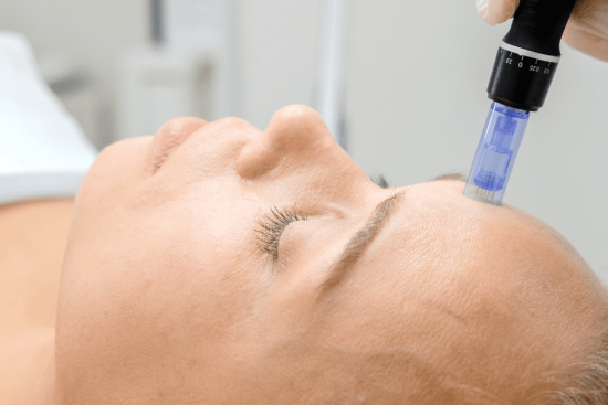 microneedling