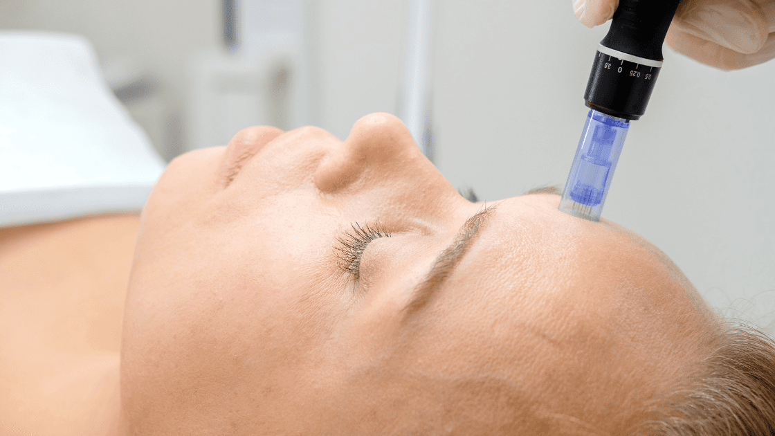 microneedling