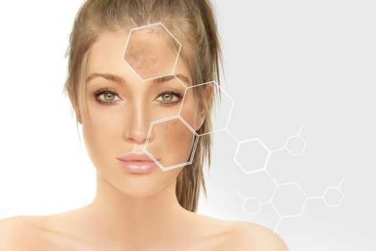 Chemical peel for dark spots