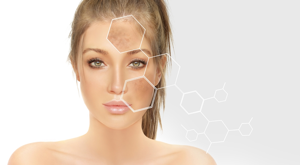 Chemical peel for dark spots