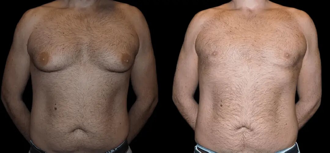 gynecomastia surgery in dubai