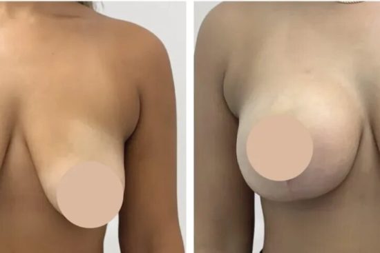 breast lift surgery in dubai