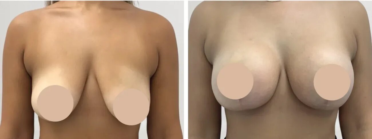 breast lift surgery in dubai