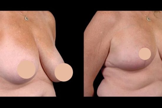 breast reduction surgery in dubai