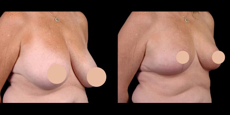 breast reduction surgery in dubai