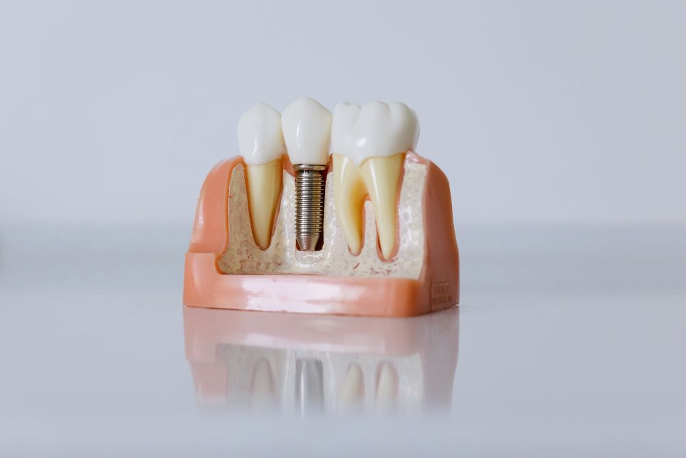 Dental Implants and Dentures